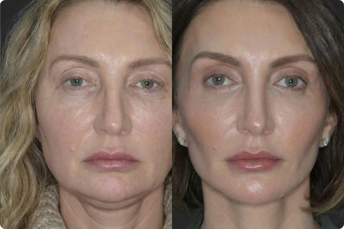 Andrea F, 49